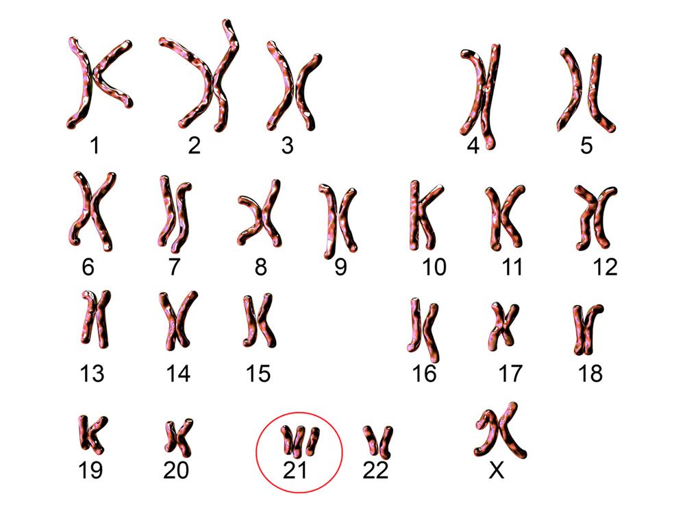 cromosoma 21